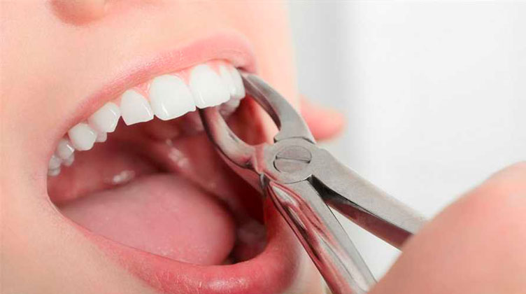 estrazione-dentale